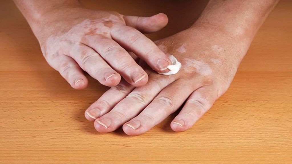 Vitiligo Creams